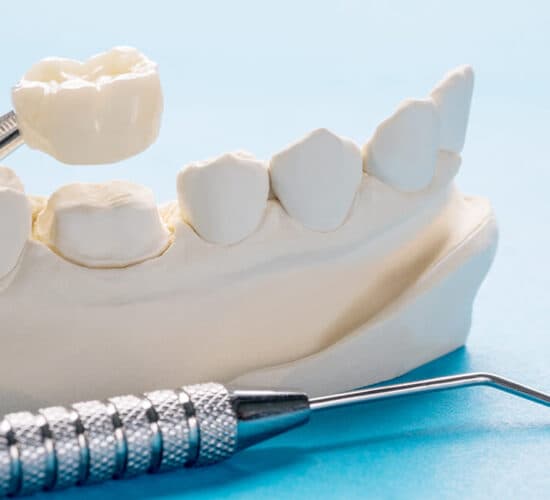 Tek diş zirkonyum restorasyon modeli